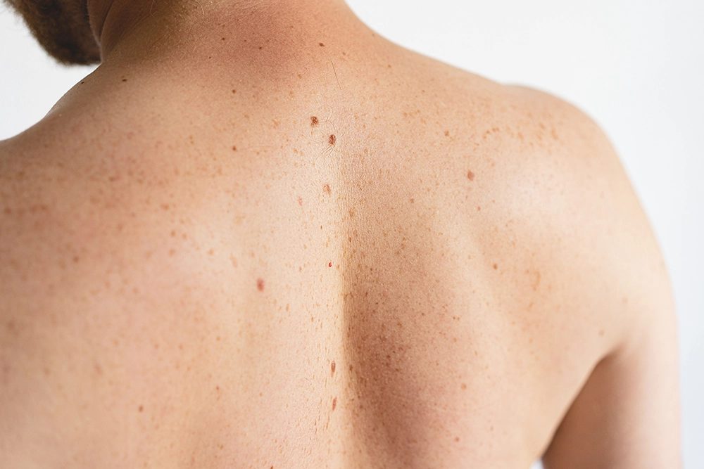 Mole Screening — Randox Health